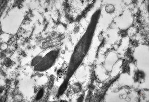 M, 43y. | myeloid leukemia … Auer bodies M, 43y. | myeloid leukemia … Auer bodies